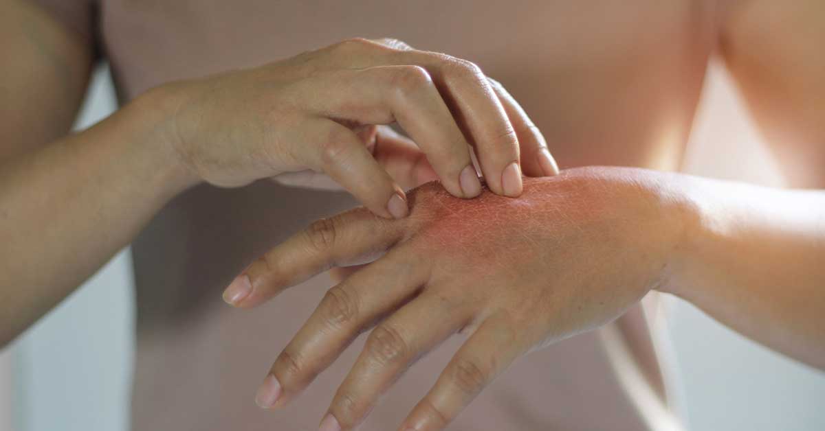 Kuruyan cilt için evde alınabilecek 10 etkili önlem
